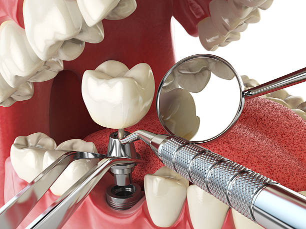Best Emergency Wisdom Teeth Removal in Green Meadows, OH
